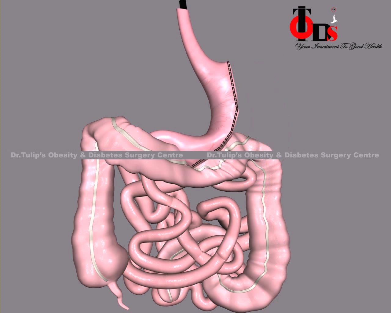 Ileal Interposition Surgery